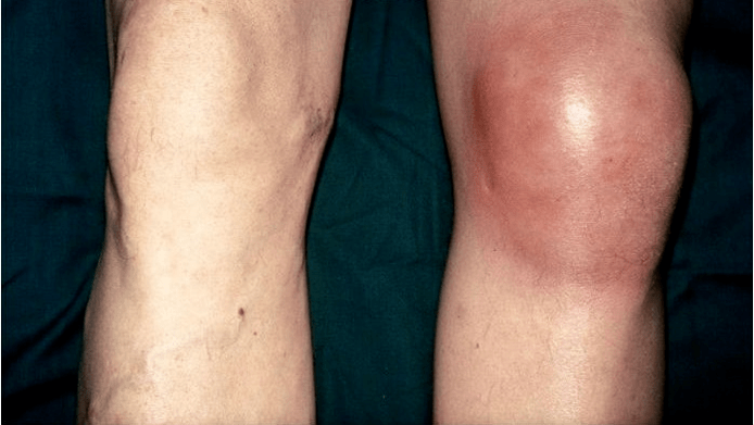 Arthrose en artritis
