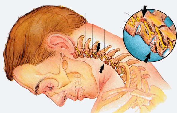 Stadia van osteochondrose van de cervicale wervelkolom